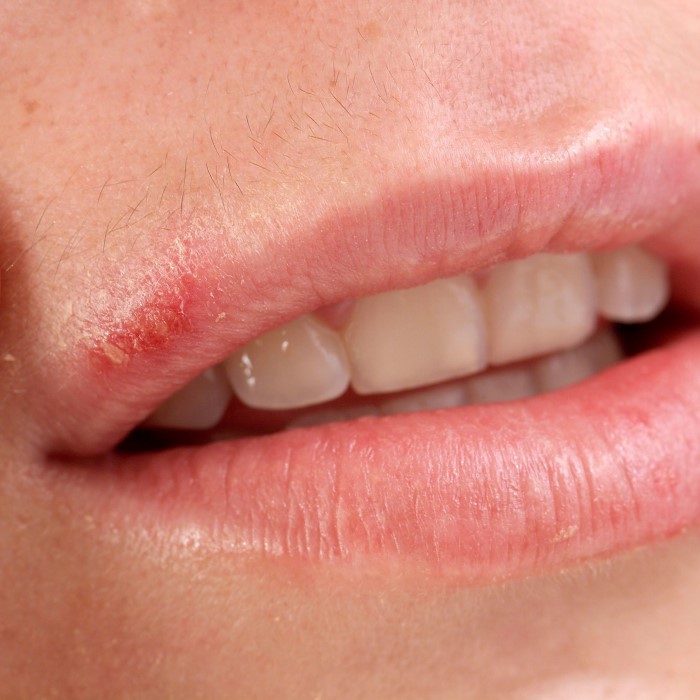 can you get herpes from a towel